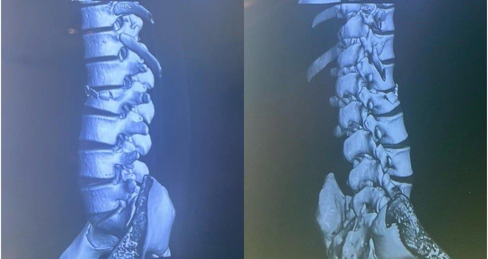 Illustrative image of spinal injury causing pain and disability if the young man falls and is not treated promptly. Photo: BVCC