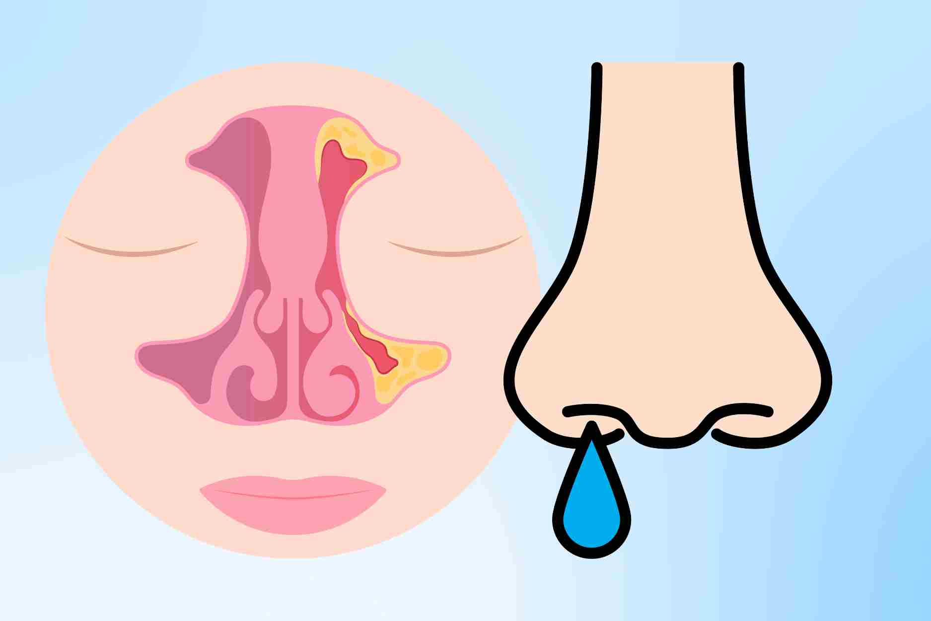 How to reduce crisis fever when the weather is cold