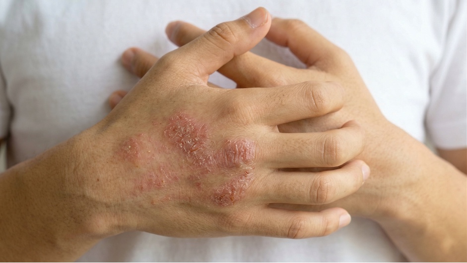 Tình trạng dị ứng khi thay đổi thời tiết. Ảnh:Thanh Trang Pharma