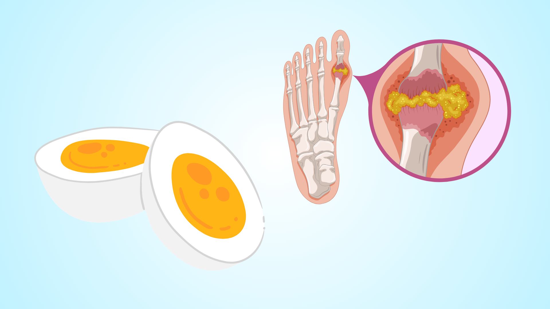 卵を食べると尿酸値を効果的に下げる方法.