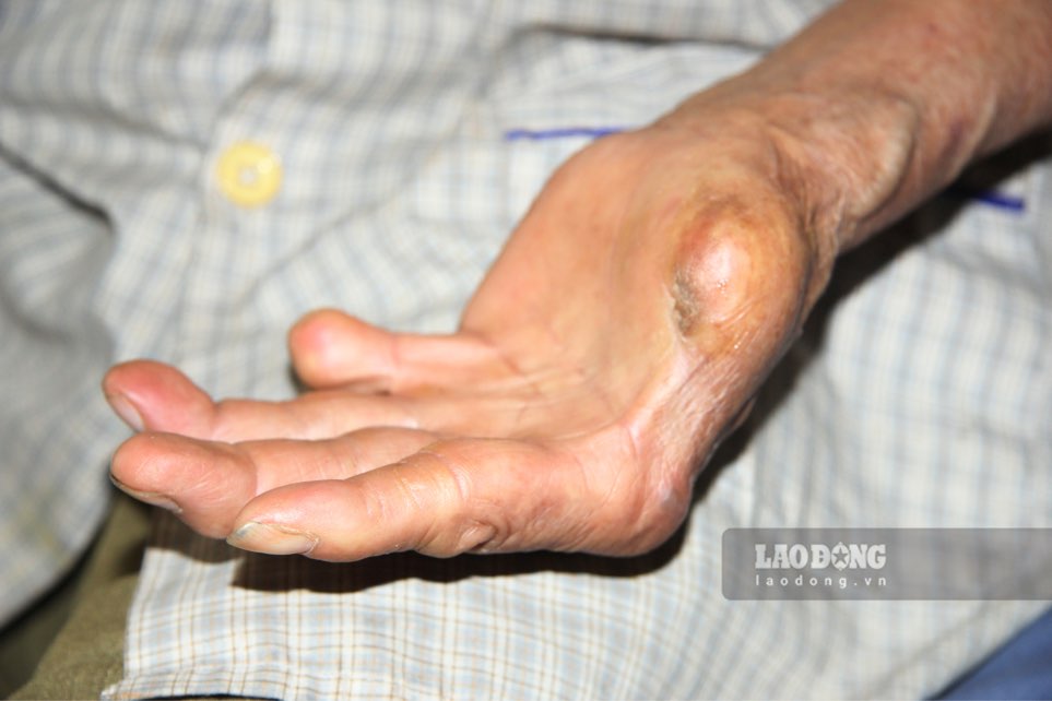 Many localities strive to eliminate leprosy in the community. Photo: Viet Bac