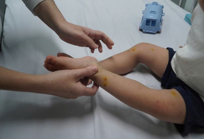 Many children get hand, foot and mouth disease. Photo: Thanh Chan