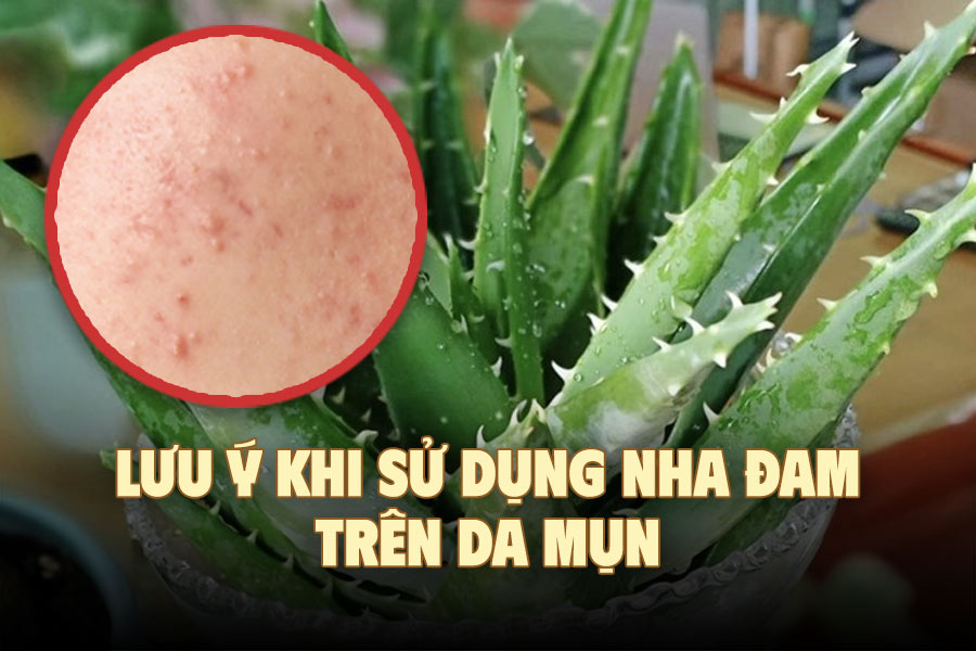 Notes when using aloe vera on acne-prone skin