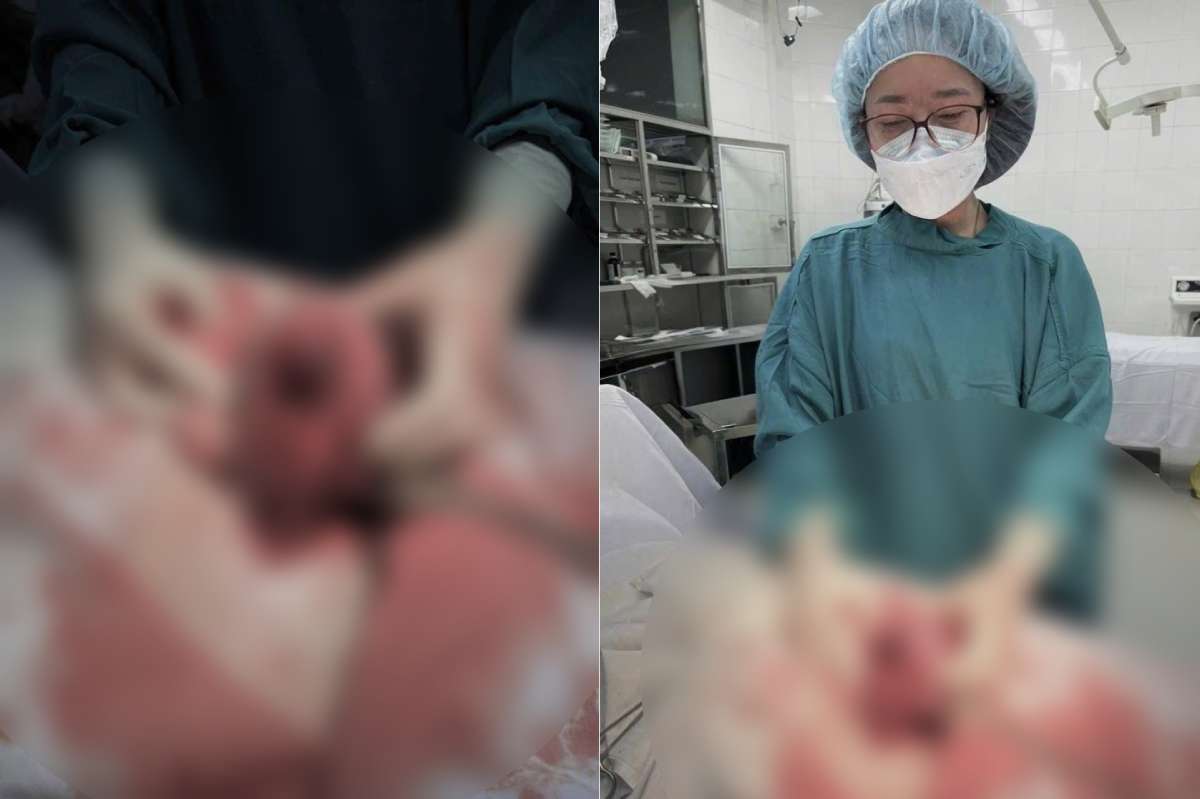 Timely rescue of pregnant woman with ruptured uterus, baby boy safely born. Photo: Thai Binh Obstetrics and Gynecology Hospital