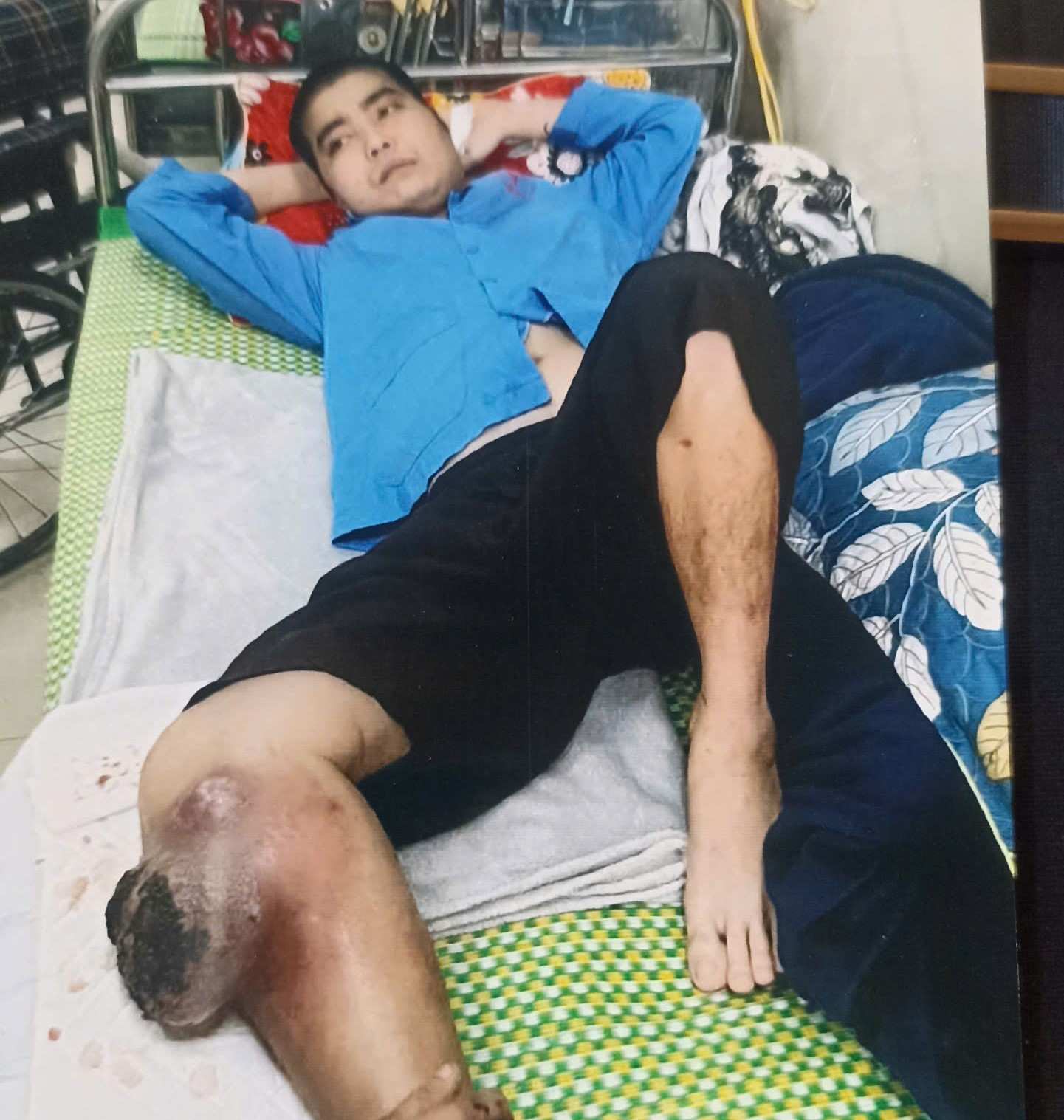 Ddến thời điểm hiện tại anh Thư đã trải qua 7 lần xạ trị và cắt bỏ một chân. Ảnh: Diệu Anh