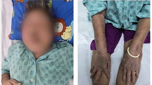 The patient was diagnosed by doctors with chronic adrenal insufficiency due to using pain relievers of unknown origin. Photo: BVCC