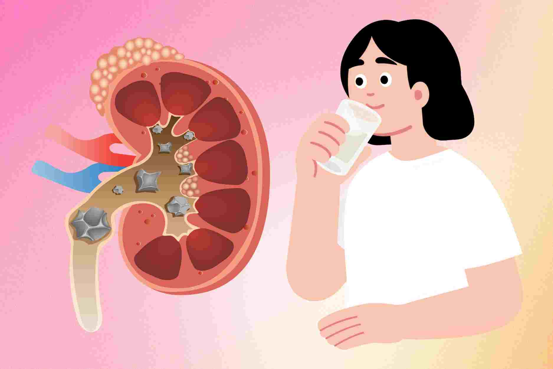 2 erreurs lors de la consommation d'eau qui augmentent le risque de calculs rénaux