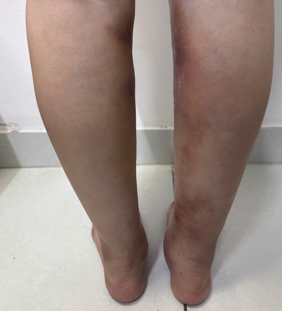 Injecting filler to straighten legs at home, 29-year-old girl has deformed legs. Photo: BVCC