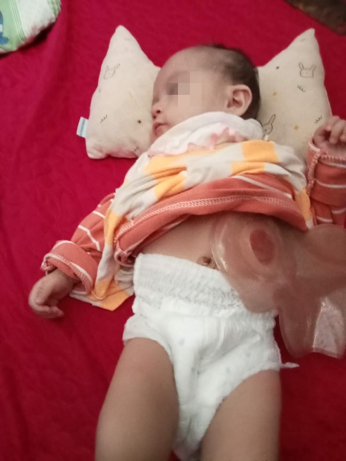 Bé Khánh Phương phải đeo túi hậu môn khi còn nhỏ. Ảnh: Gia đình cung cấp