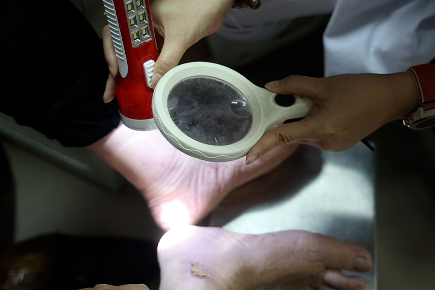 Một bệnh nhân bị vấn đề da liễu do việc đi giày, tất vào mùa nắng nóng. Ảnh: Dương Anh