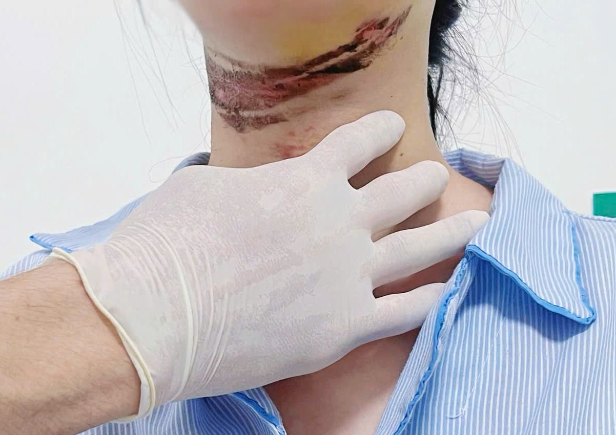 길 한복판에서 전선에 걸려 목에 부상을 입은 여학생. 사진: 꽝빈 우호 병원