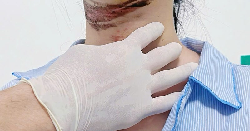 Nữ sinh TP.HCM bị thương ở cổ do vướng dây điện đứt trên đường