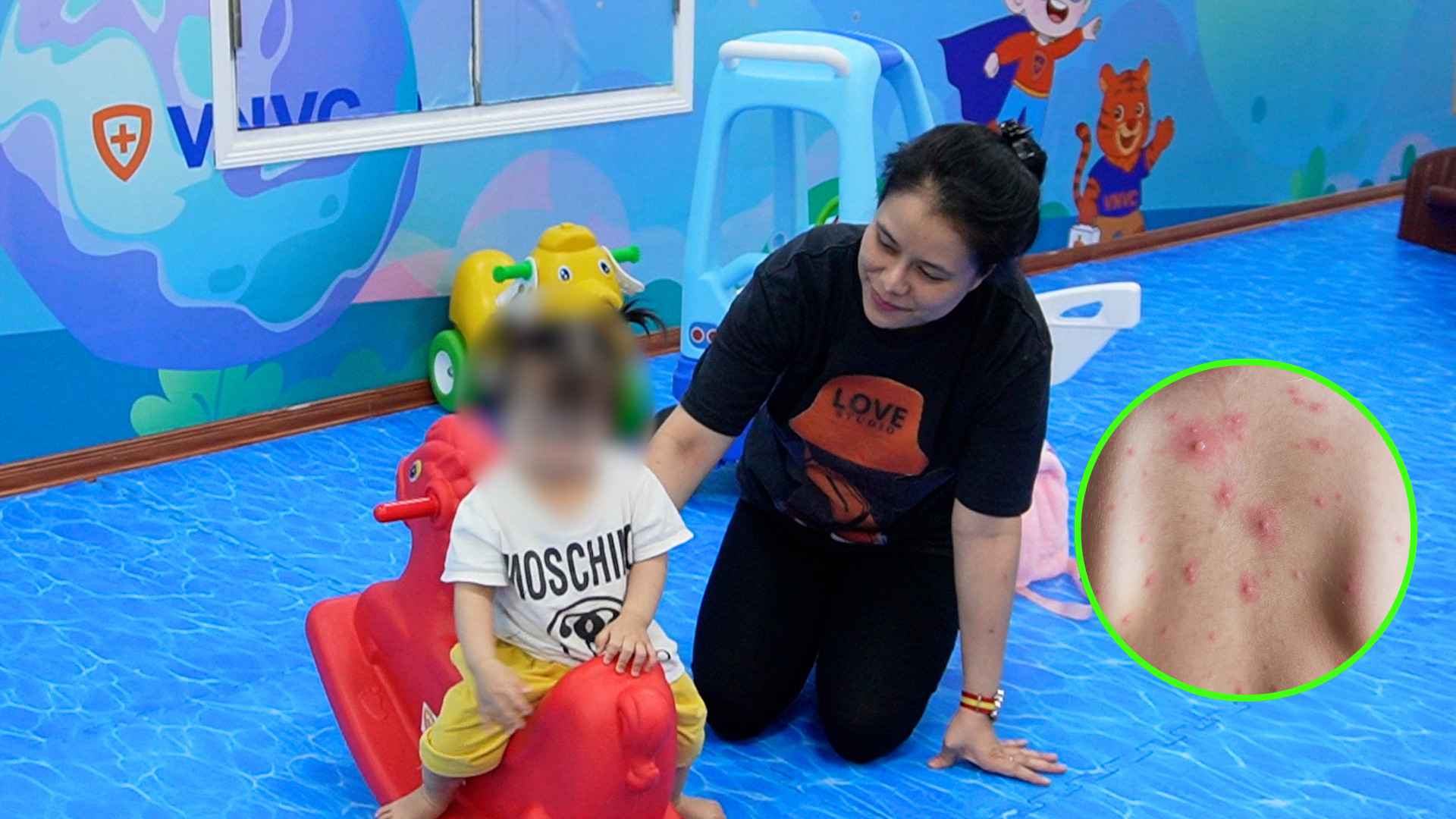 Chickenpox is in season, many families take their children for early vaccination.