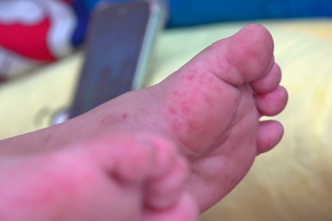 Supervisar de cerca las manos, pies y boca, proteger a los niños menores de 5 años. Foto: Ta Quang