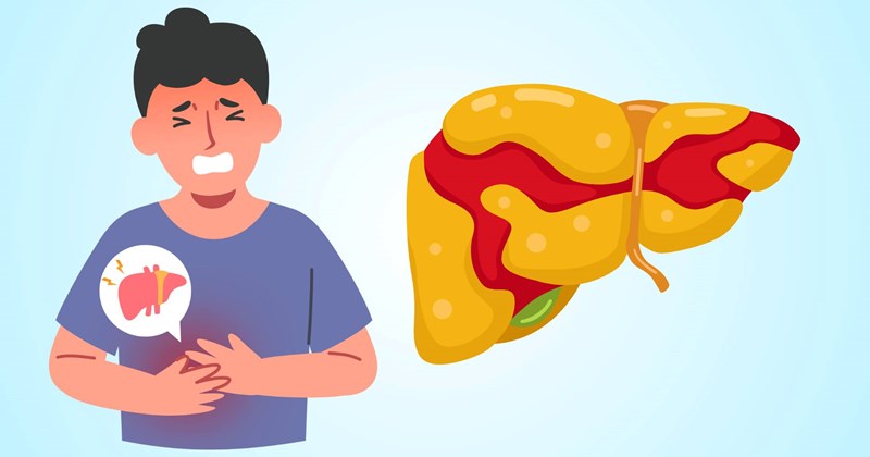 Ngoài rượu bia, 3 đồ uống quen thuộc này cũng gây gan nhiễm mỡ