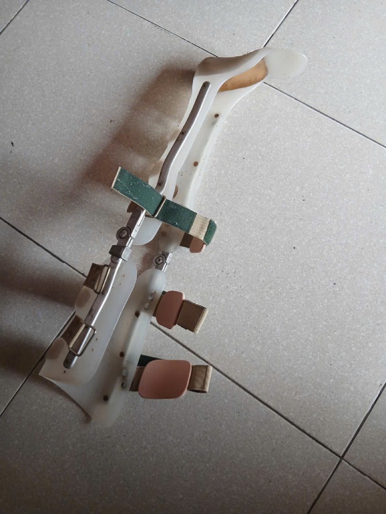 Chiếc nẹp chân cũ đã gắn bó 10 năm với chị Huế. Ảnh: NVCC