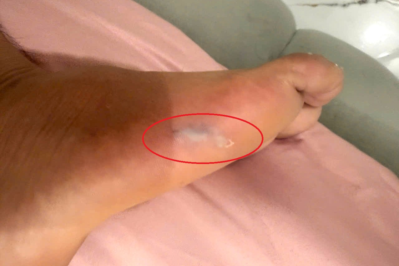 Gai cá đuối đâm thủng bàn chân người tắm biển ở Vũng Tàu. Ảnh: NDCC