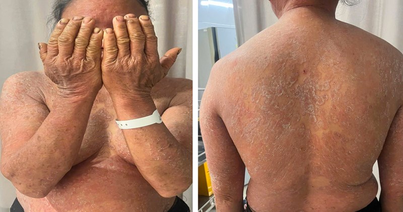 Tự ý dùng thuốc bôi, nấm da lan rộng khắp cơ thể