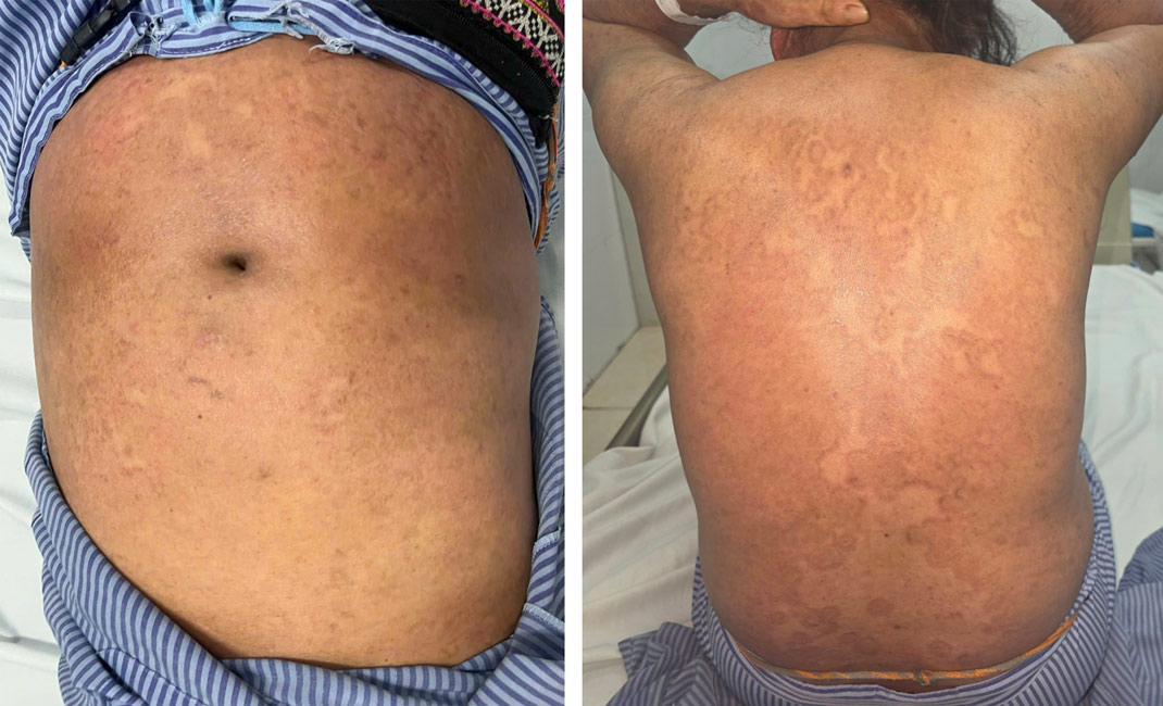 Tổn thương da của bệnh nhân cải thiện sau 3 ngày điều trị. Ảnh: BVCC