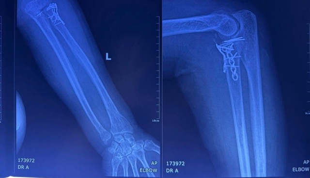 X-rays after surgery showed that the spinal cord, pericarpian incision, and elbow joint had been corrected and fixed well. Photo: BVCC