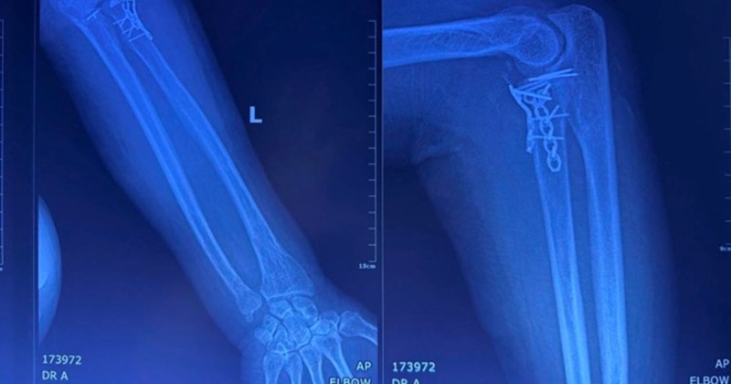 Gãy xương phức tạp kèm trật khớp ở người cao tuổi