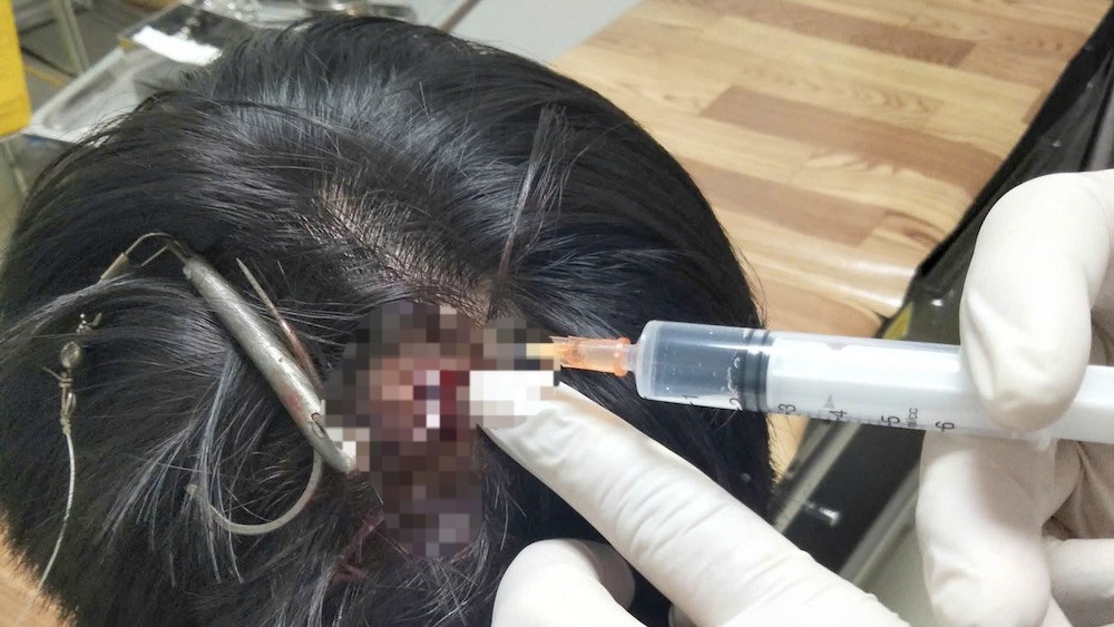 Doctors anesthetize the victim to remove the hook from the top of her head. Photo: Quang Binh Friendship Hospital