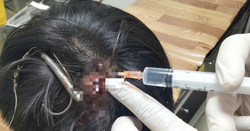 Thiếu niên bị lưỡi câu ba tiêu cắm vào đỉnh đầu