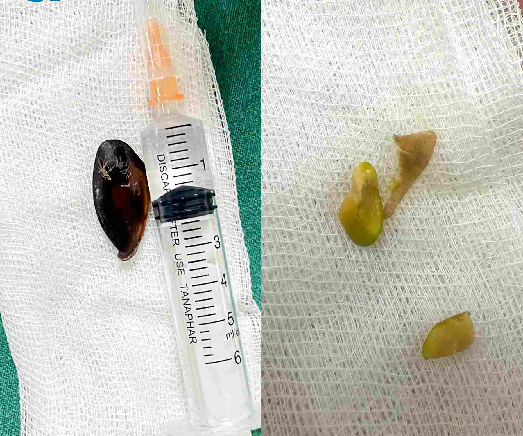 Images of foreign objects such as sapodilla seeds and pistachios in the airway taken out. Photo: BVCC