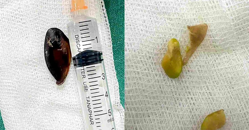 Hạt sapodilla trong đường thở bé trai 13 tháng