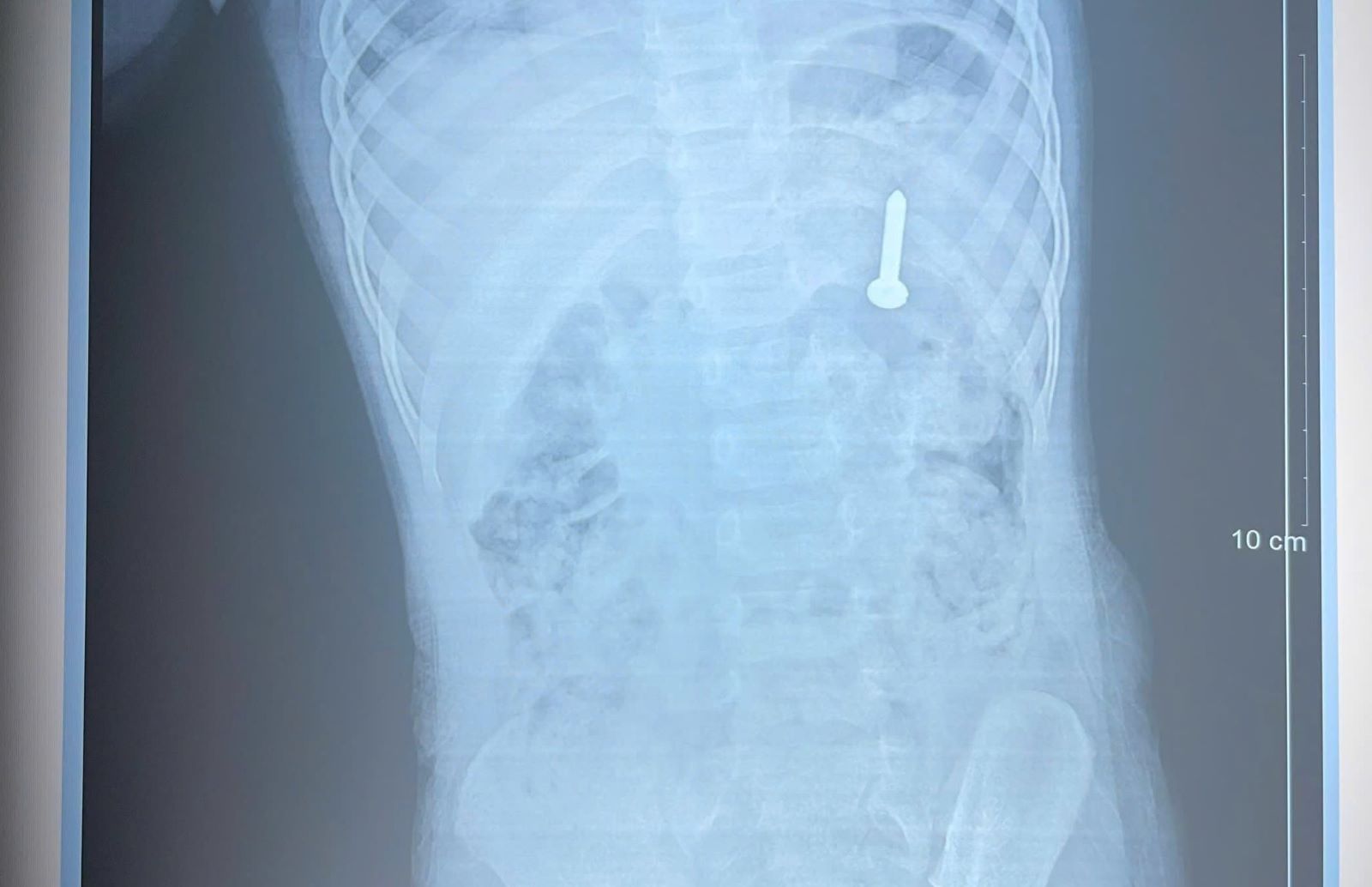 X-ray results showed a screw in the baby's body. Photo: Quang Tri Provincial General Hospital