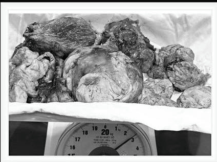 The 2.7kg fibroid tumor was successfully removed by doctors. Photo: BVCC