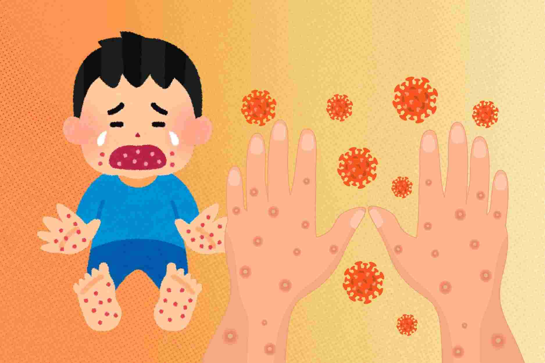 Cómo prevenir la enfermedad de manos, pies y boca en niños