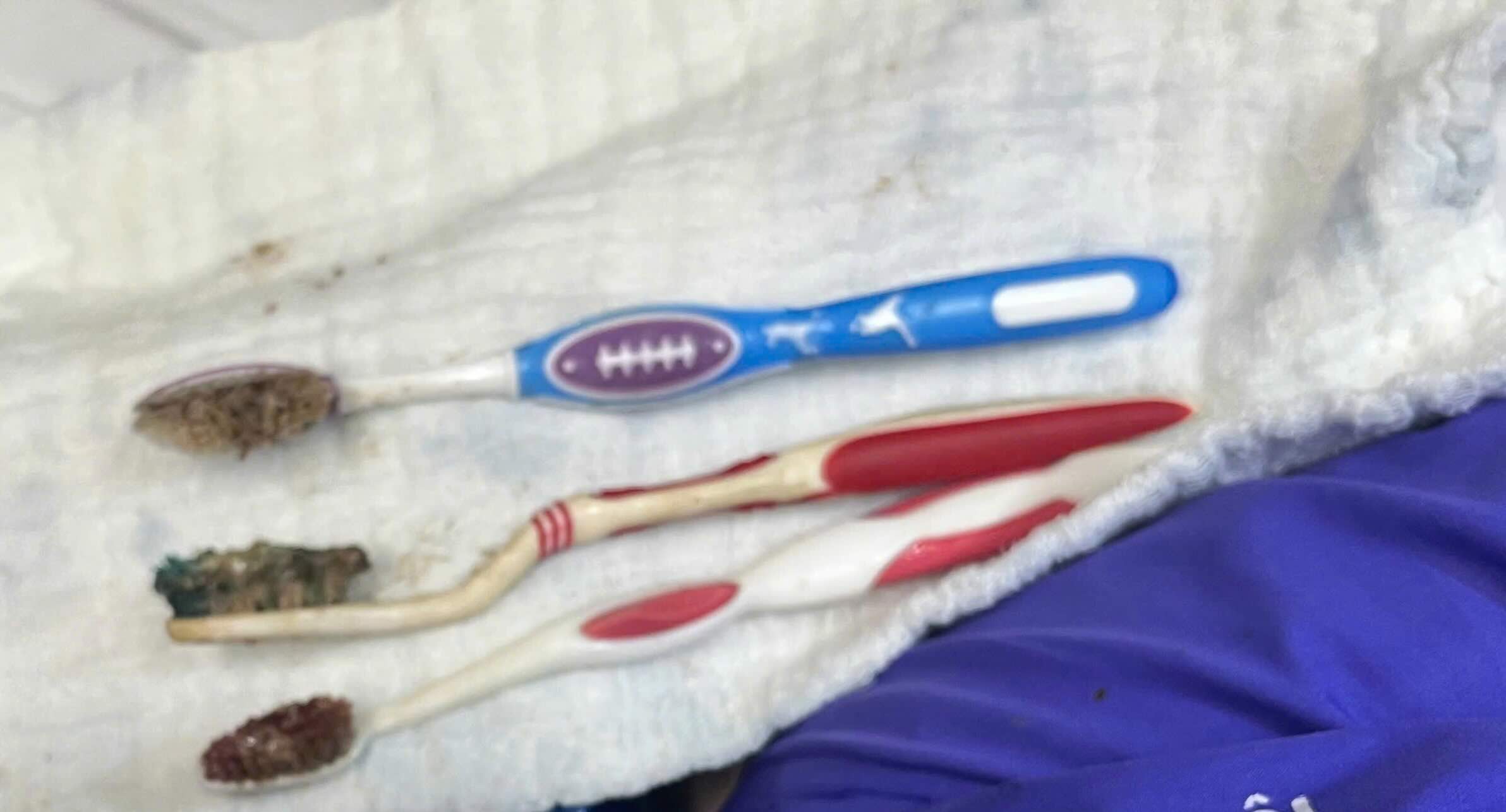 3 toothbrushes taken from the digestive tract by interventional endoscopy. Photo: Nhu Hien.