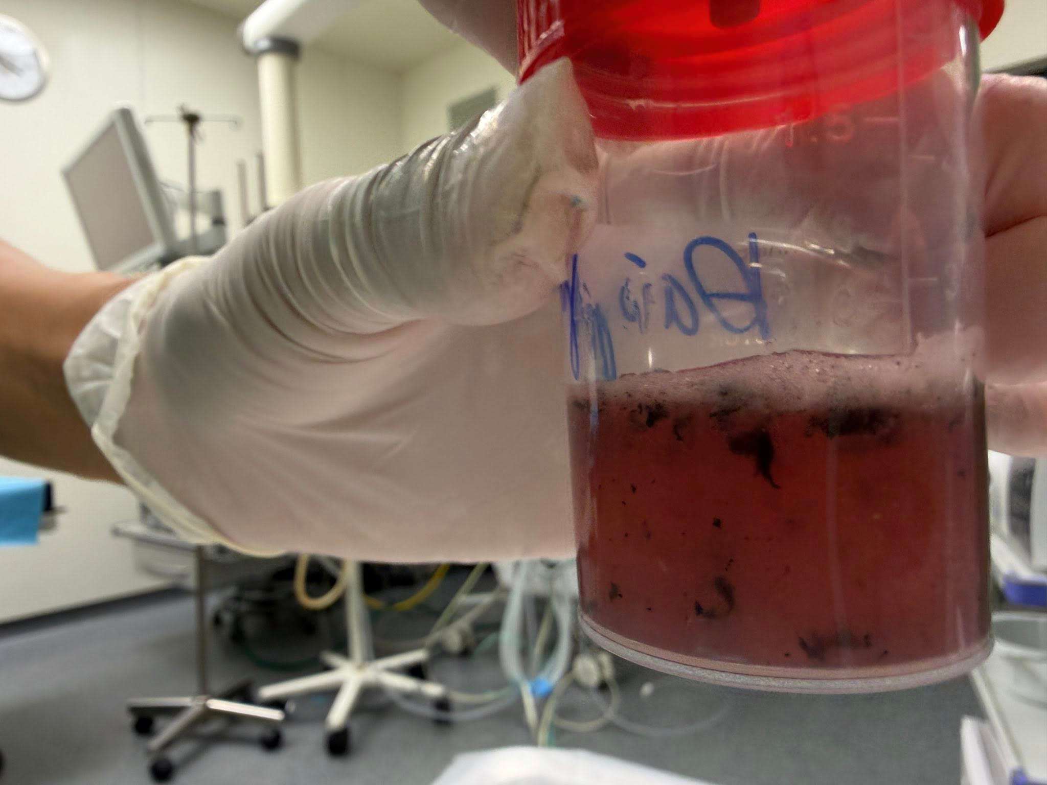 Nước rửa phổi của nạn nhân. Ảnh: BVCC