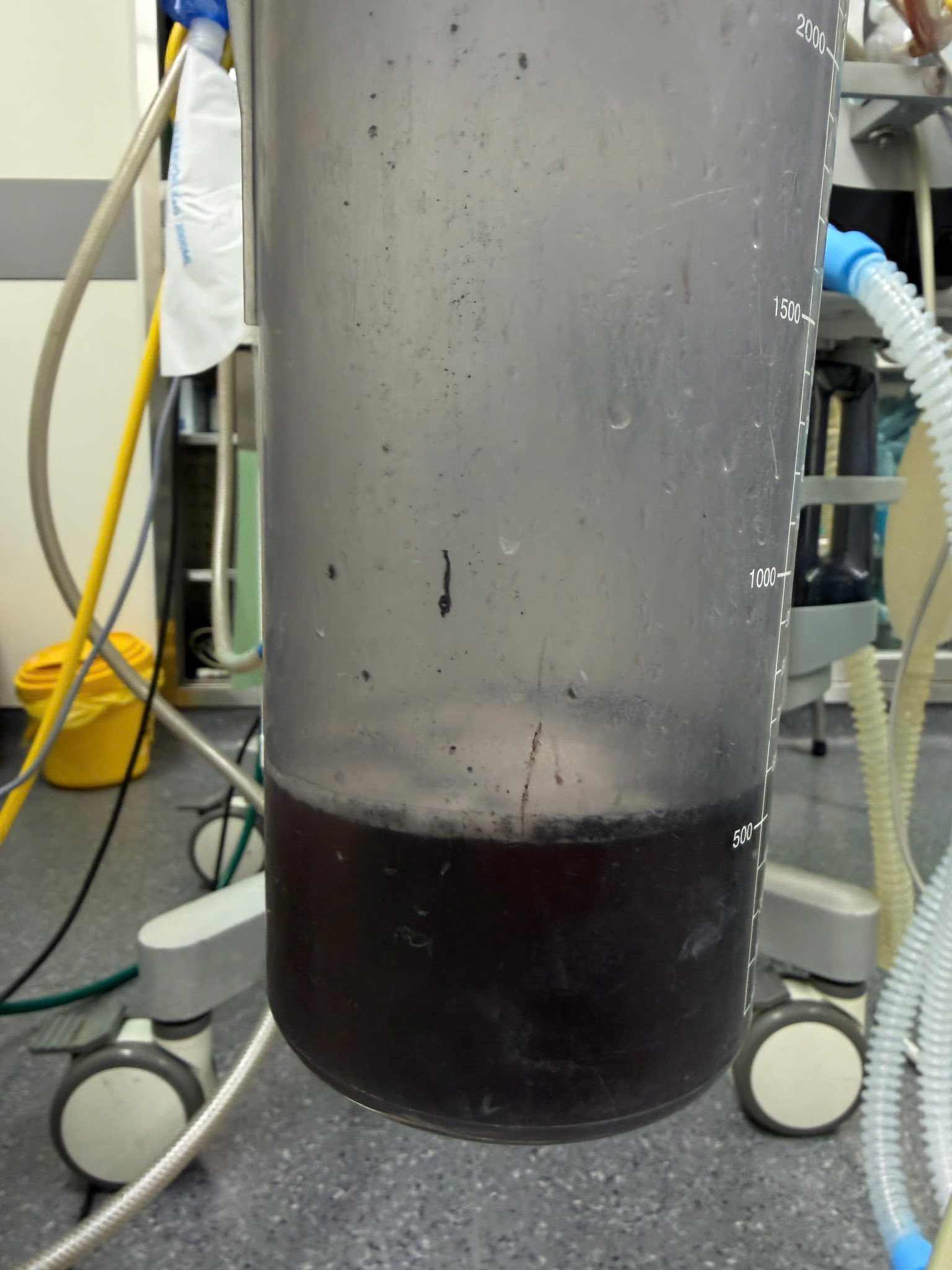 Nước rửa phổi của bệnh nhân. Ảnh: BVCC