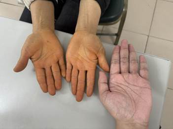 When orange-yellow skin is not caused by liver disease. Photo: BVCC