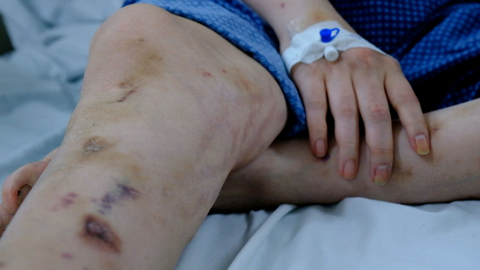 Self-medicating gout, a male patient suffers from kidney failure and muscle atrophy.