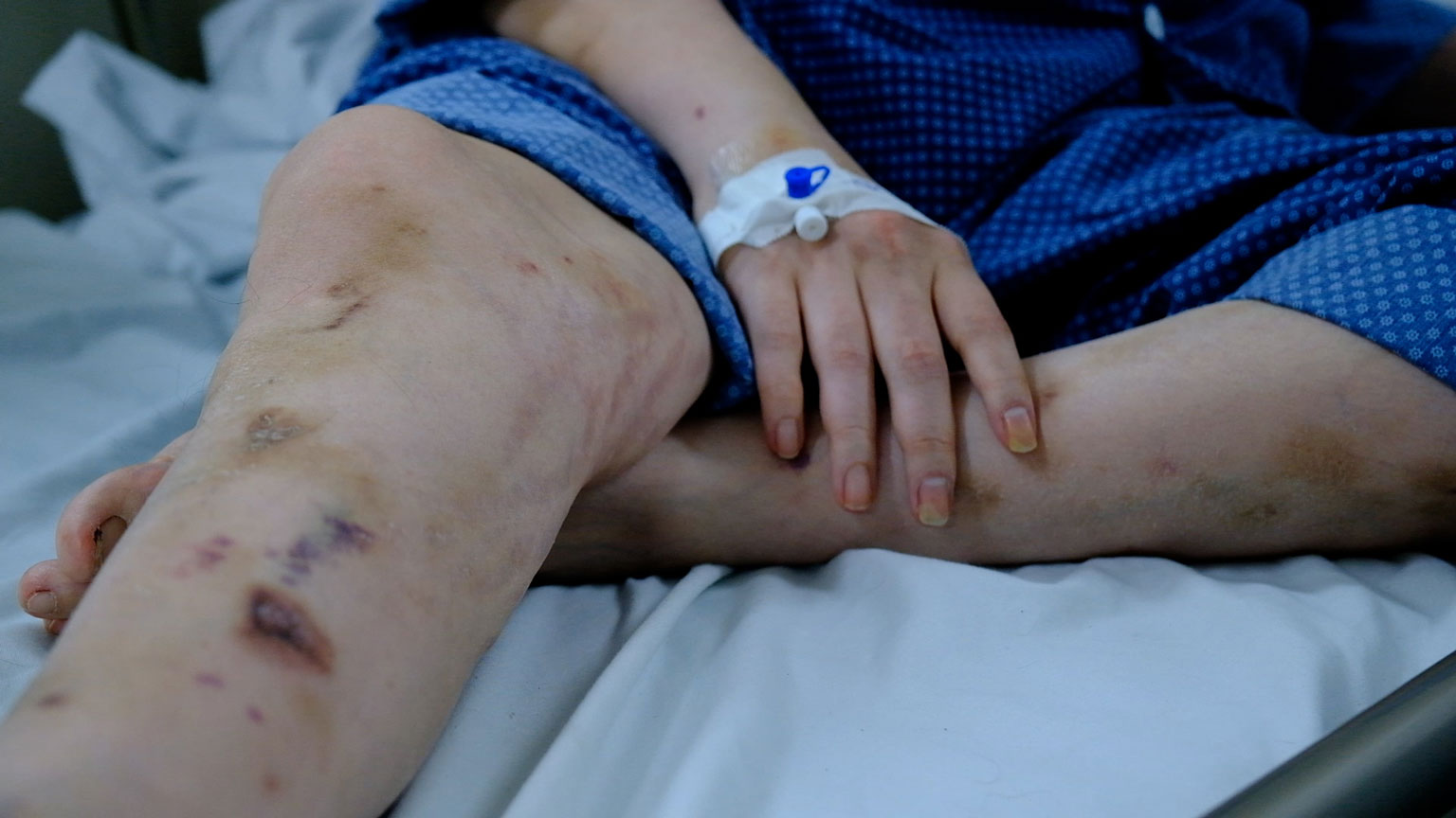 Tay chân bệnh nhân bị teo cơ và xuất hiện nhiều vết bầm do ảnh hưởng của bệnh. Ảnh: Mỹ Ly