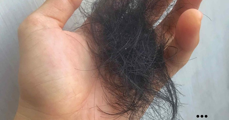 3 thói quen gây rụng tóc nhiều