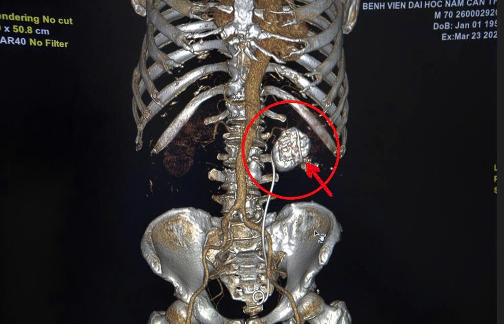 Viên sỏi san hô và ống sonde JJ của bệnh nhân qua chụp MRI. Ảnh: Bệnh viện cung cấp