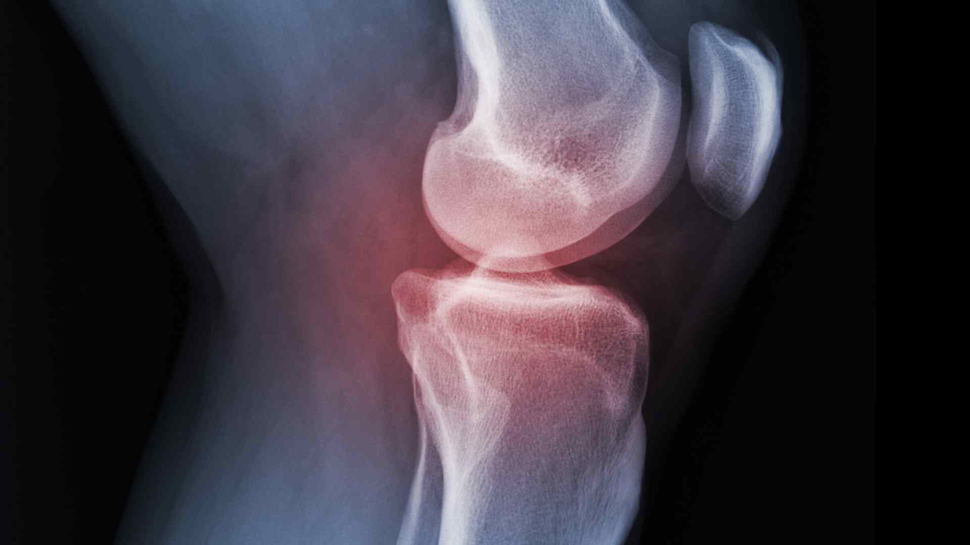 Osteoporosis is a condition where bone mineral density decreases by 2.5 standard deviations or more compared to healthy young people of the same sex. Graphic photo: Nguyen Ly