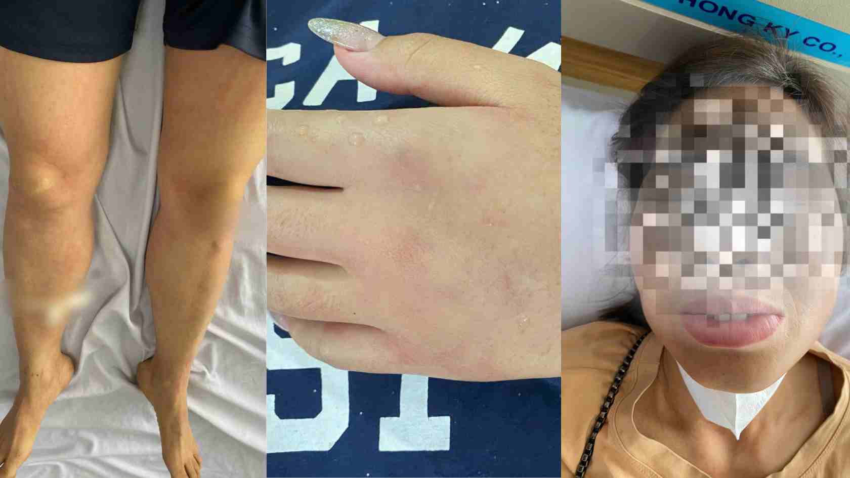 Cases of bee stings requiring emergency treatment at Lang Son Provincial General Hospital. Photo: BVCC