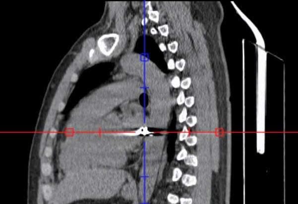 Vị trí viên đạn. Ảnh: Bệnh viện Đa khoa Thống nhất Đồng Nai