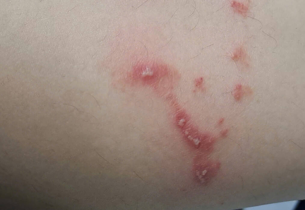 Foods to avoid when having herpes zoster to avoid leaving scars. Photo: Khanh Linh