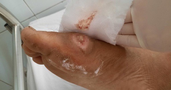 Damage caused by Whitmore's disease bacteria. Photo: BVCC