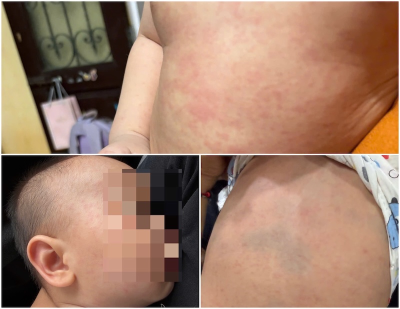 A baby has a red rash all over his body after having a fever for a few days, suspected of being hand, foot and mouth disease. Photo: Thuy Linh
