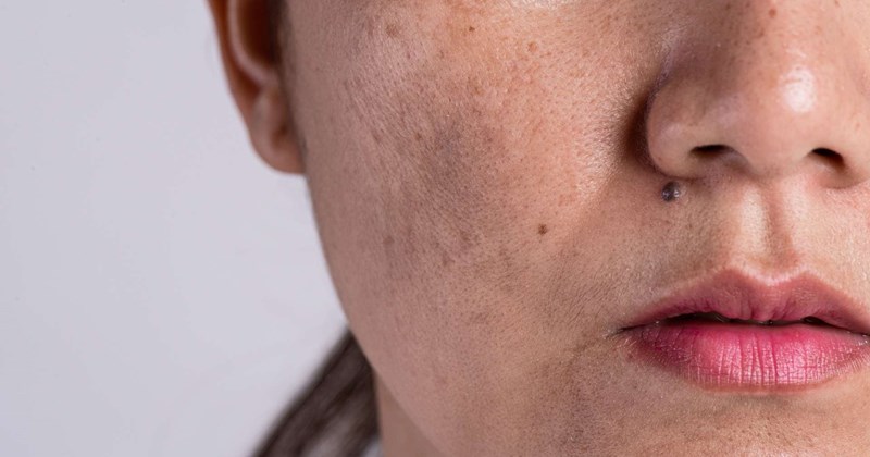 Vì sao da sạm đi dù không tiếp xúc với ánh nắng?