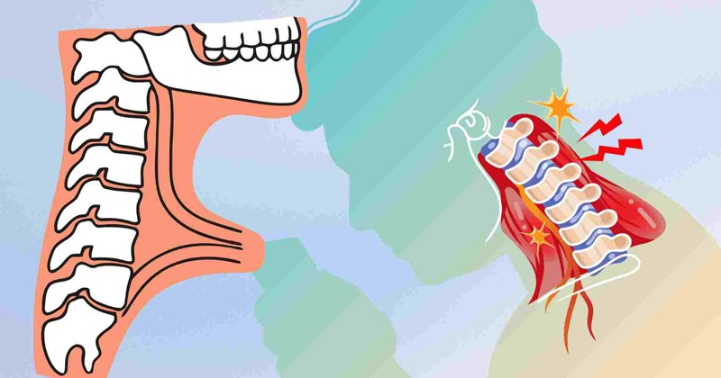 Nhận biết sớm dấu hiệu thoái hóa đốt sống cổ để tránh biến chứng