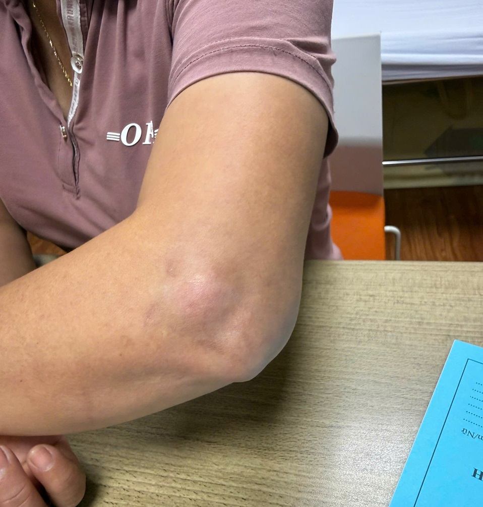 Impersonating a doctor to inject medicine to patients, but after injection the pain condition does not improve, the injection area appears to have subcutaneous atrophy. Photo: Nguyen Ha