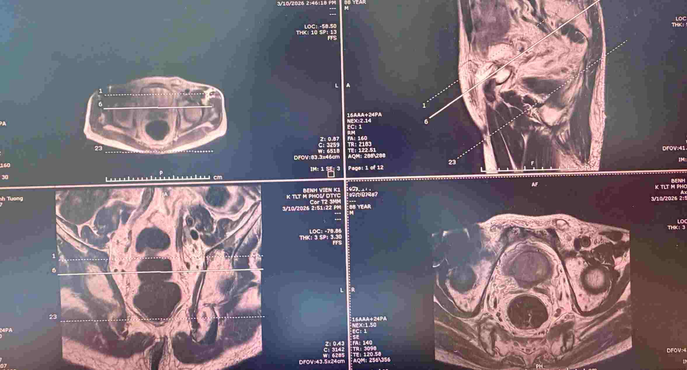 Targeted biopsy helps detect late-stage cancer. Photo: Tran Ha
